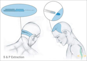 Published articles on possibilities and limitations of modern hair transplantation techniques
