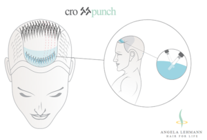 New article on self-hair transplantation published using crosspunch method