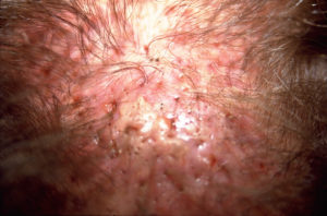 Sichtbare Entzündungen und Narbengewebe durch Kunsthaarimplantate auf der Kopfhaut eines Mannes in Nahaufnahme