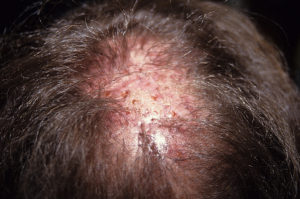 Sichtbare Entzündungen und Narbengewebe durch Kunsthaarimplantate auf der Kopfhaut eines Mannes