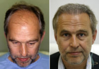 Links: vorher / rechts: 8 Monate nach dritter Operation (total 2800 Grafts)