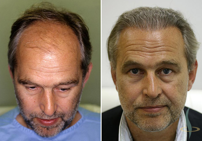  Left: before / right: 8 months after 3rd operation (total 2800 grafts)