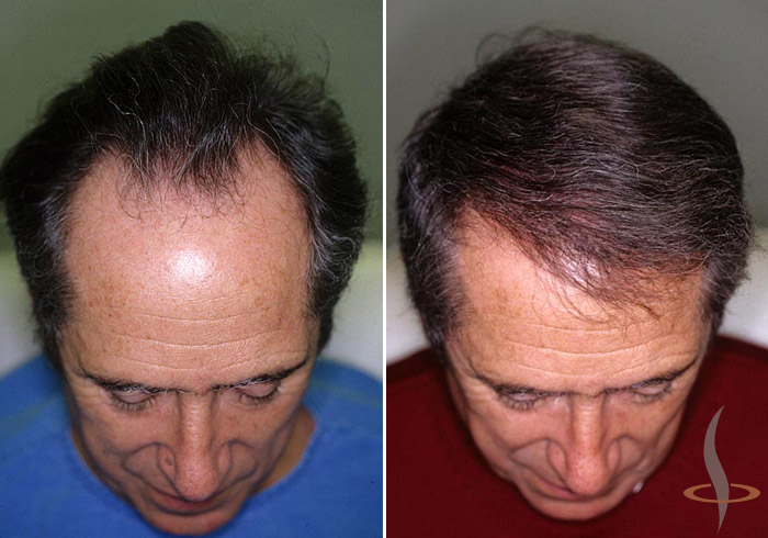 Left: before / right: 2 operations (total 1280 grafts)