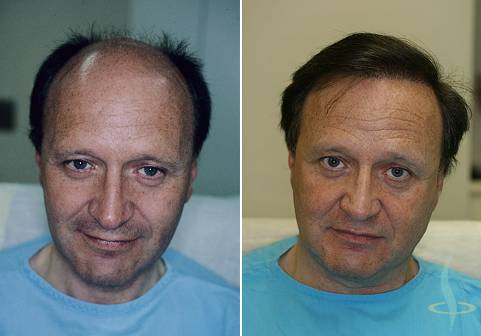 Left: before / right: after 3rd operation