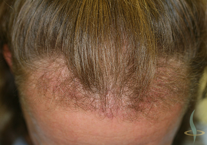 Hairline after 1st operation