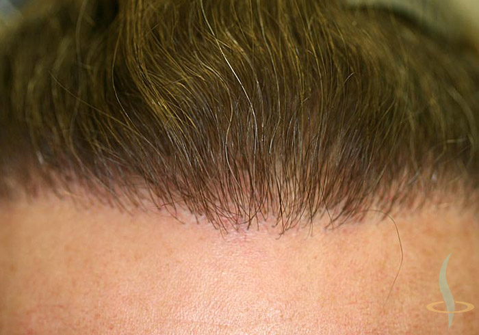 Hairline after 2nd operation