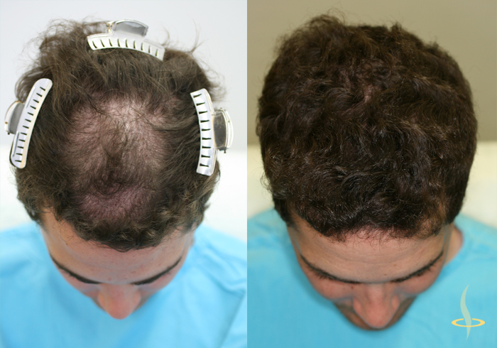 Patient H-28 - 3 operations - 1350 Grafts ~8000 hair follicles -  Haartransplantation Haarverpflanzung