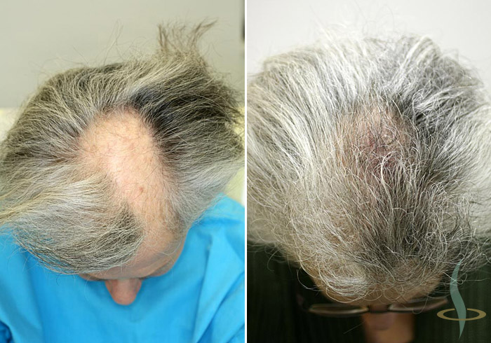 Patient K-05 - 2 operations - 1060 Grafts 5000 hair follicles - Haartranspl...