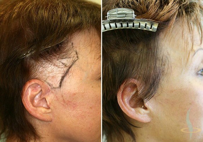 Patient K-06 - 1 operation - 200 Grafts ~800 hair follicles -  Haartransplantation Haarverpflanzung