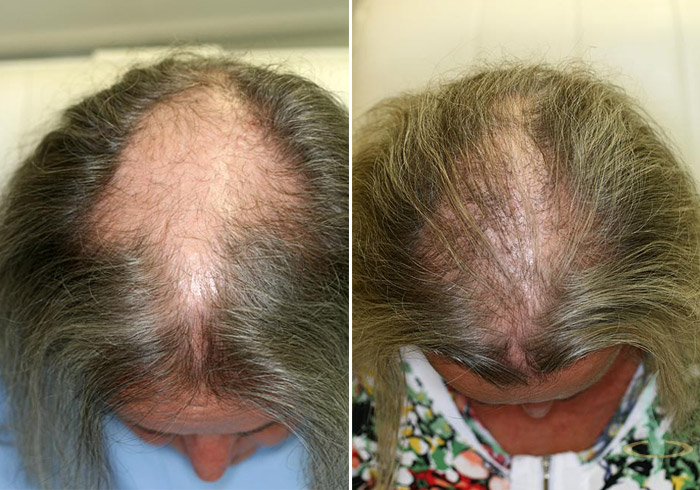 Patient K-08 - 1 operation - 410 Grafts 2000 hair follicles 