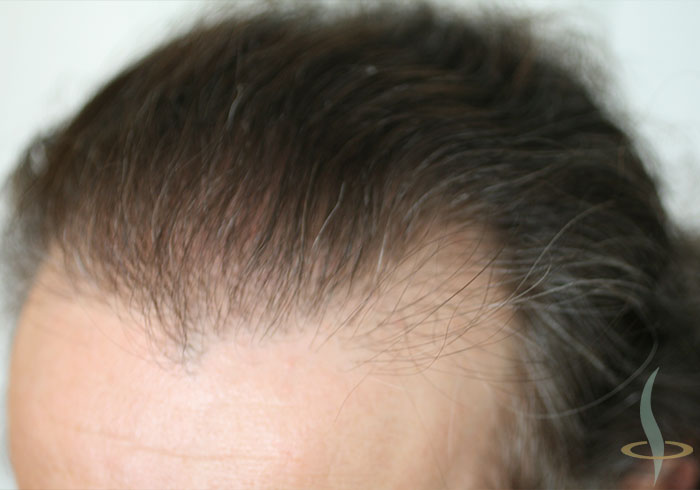 Hairline on the left after the second operation