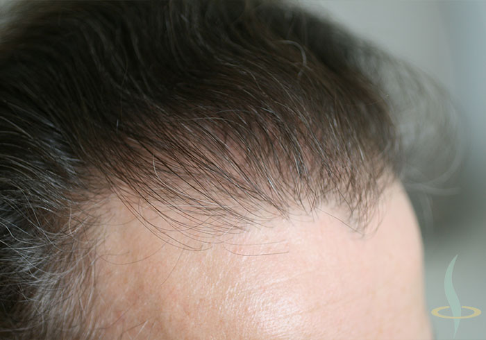 Hairline on the right after the second operation