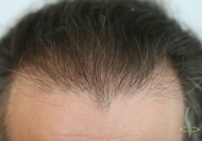 Hairline after the second operation