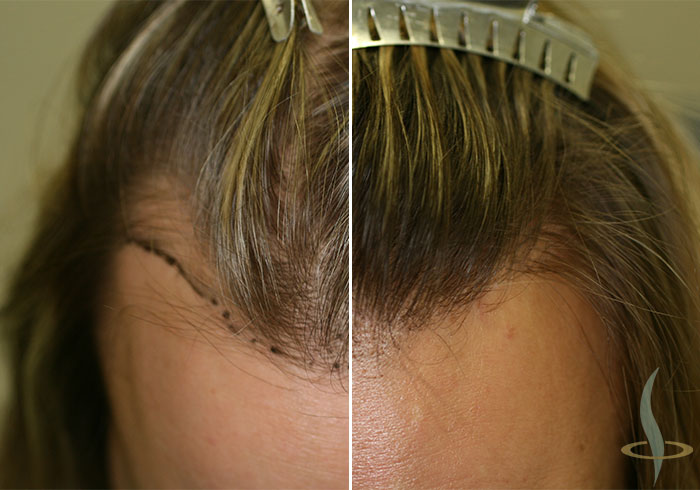 Vor und nach der 2. Operation