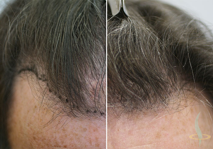 Vor und nach der 2. Operation