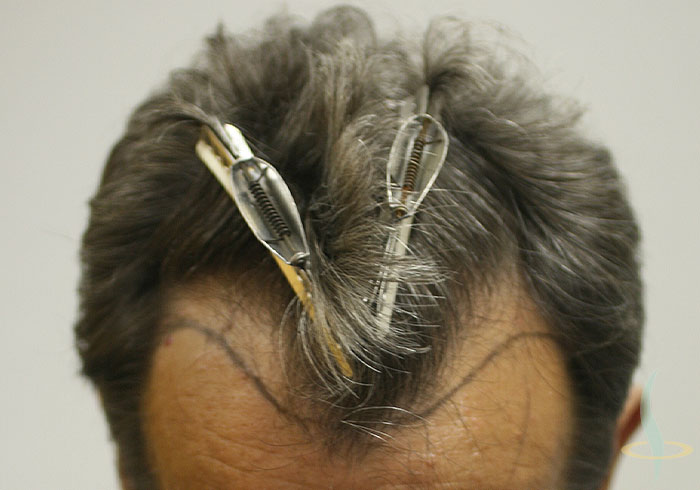 Before Surgery (with Hairline)